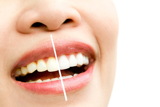Are you looking for effective teeth whitening options in Pune? Dr. Nilesh Khandare, a recognized… post image