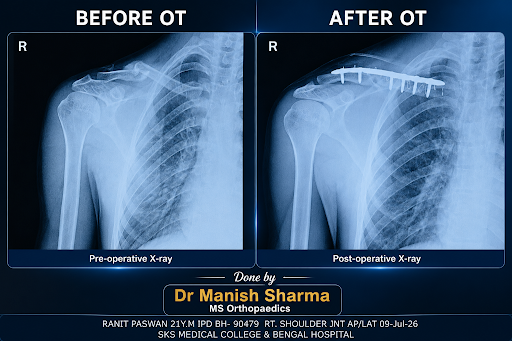 Young boy met with an accident and unfortunately broke his right clavicle . An Emergency OT done…