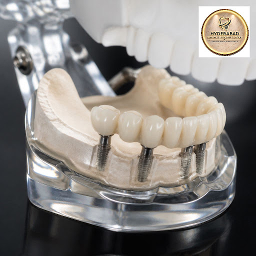 Struggling with missing teeth or a failed implant and searching for a reliable dentist near me? A… post image