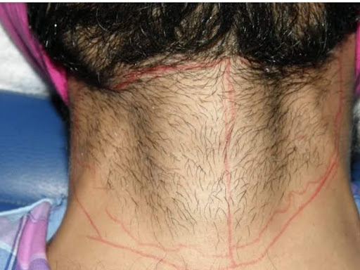 Beard hair correction by Laser  hair removal. post image