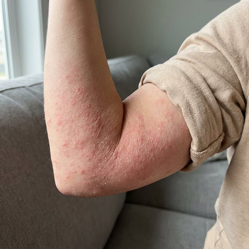 Struggling with eczema, dry skin, or itchy rashes? Get exper