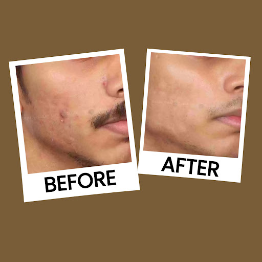 Here are some Ayurvedic treatments for pimples: post image