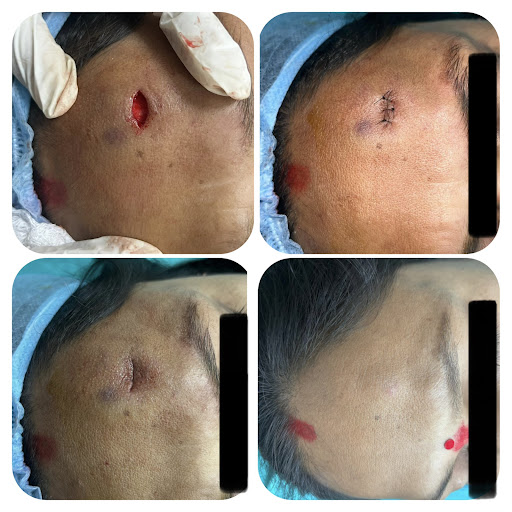 No scar