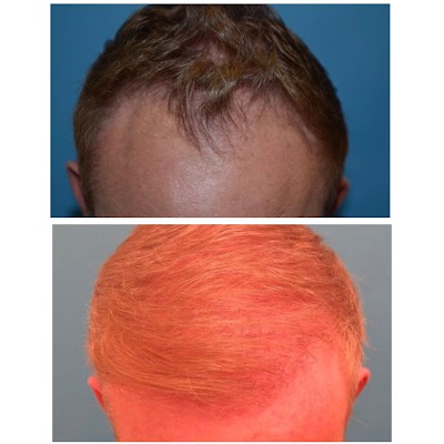 UFP Hair Restoration