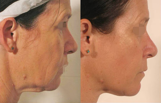 Jan-Val Aesthetics NON SURGICAL FACELIFT & TUMMY TUCK EXPERTS Based In Ballyclare - Thumbnail