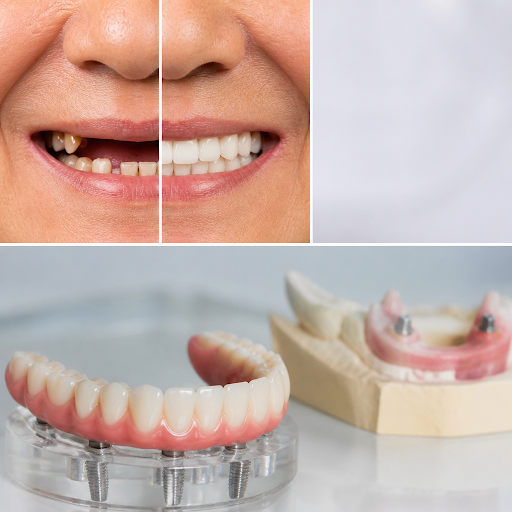 Thinking about a complete smile makeover with full mouth dental implants? At Parmarth Dental Hosp… post image