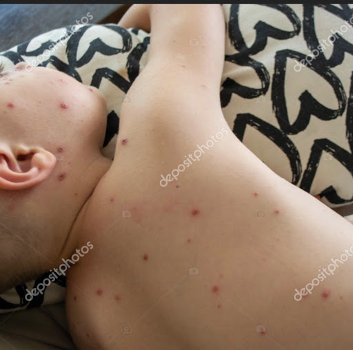 Chicken pox is spreading  post image