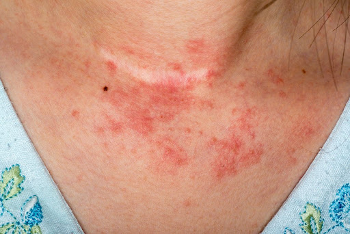 Struggling with an itchy, red neck rash or skin allergy? Get