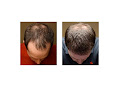 Hair transplant clinic Bosley - Hair Restoration & Transplant - Richmond in Richmond