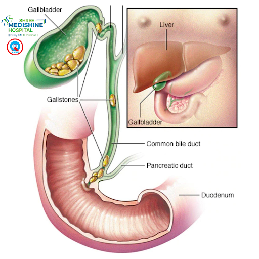 Gallstones are hardened deposits that develop inside the gallbladder. While some people may have…
