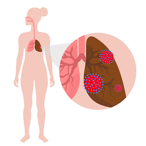Silicosis is a serious lung disease caused by prolonged inhalation of fine silica dust, often fou… post image