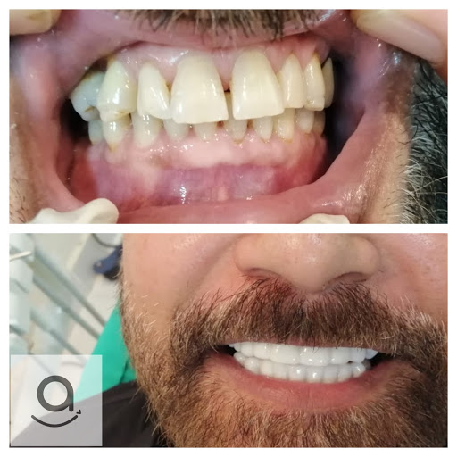 Alpha Veneers - Visual