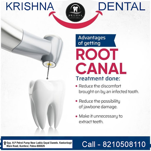 Advantages of RCT ( Root Canal Treatment)
