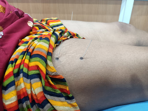 Dry needling for OA in knee joint