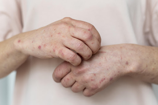At Tanush Skin Care Clinic in Bhiwandi, we provide comprehensive dermatology evaluation and perso… post image