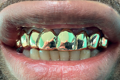 Where Can I Buy Gold Teeth Near Me