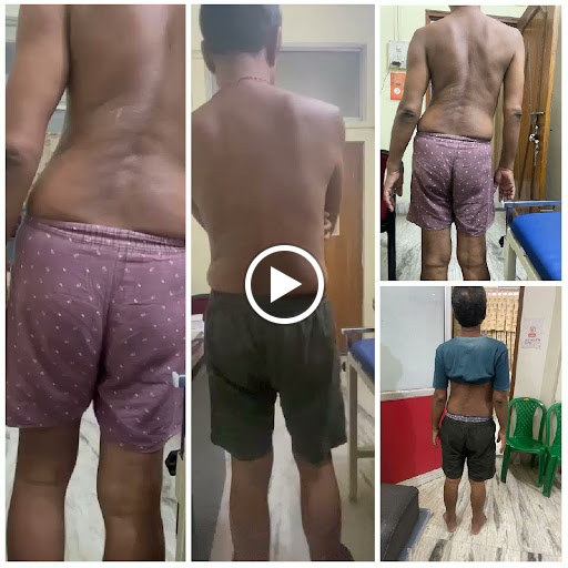 Pelvis drop with l4-l5 spondylitis, after session, patient now go back his normal life . post image