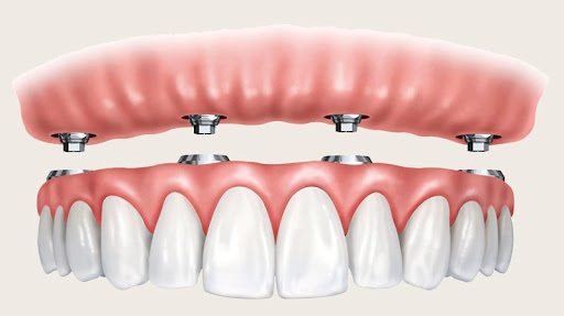 Rider Oral Surgery Gallery - United States