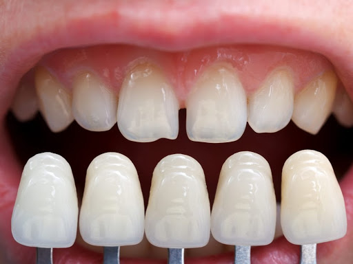 http://dentalclinicahmedabad.in/ceramic-and-veneer-cap.php