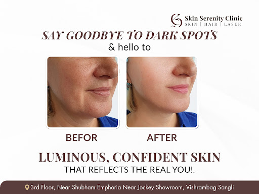 Dark spots, pigmentation, and blemishes can now be treated with expert care at Sangli's Top Rated… post image