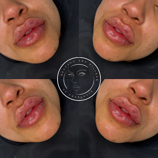 Beautox and Fillers of Charlotte