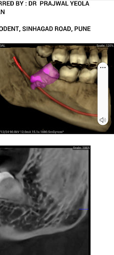 Extraction of wisdom tooth close to nerve post image