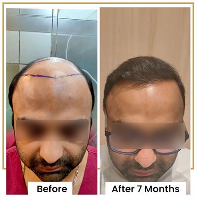 Embrace a new you this monsoon with iGraft Hyderabad's exclusive hair…
