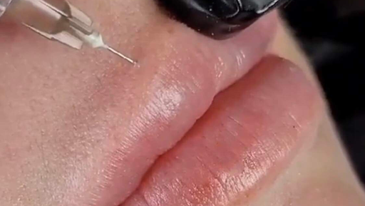 AGS Cosmetic Injections “Ms. Botox of Idaho”