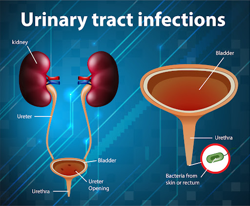 Urinary tract infections (UTIs) can affect the bladder, urethra, or other parts of the urinary sy… post image