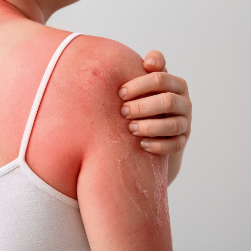 Sunburn can damage your skin faster than you think! If you'r