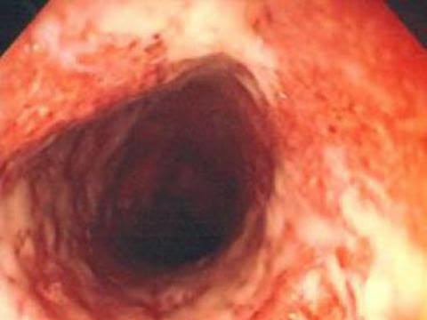ULCERATIVE COLITIS.  post image