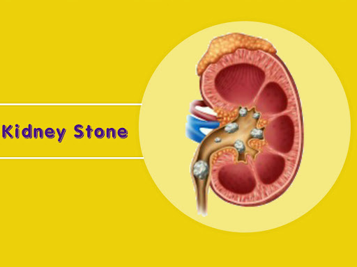 KIDNEY STONE  homeopathic treatment post image