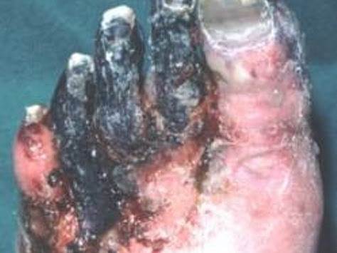 GANGREN E AND HOMEOPATHIC TREATMENT post image