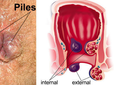 PILES post image