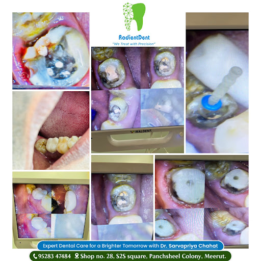 "We Treat with Precision" Looking for the best RCT specialist in Meerut? RadiantDent is here to p… post image