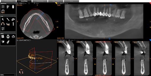 "CBCT vs OPG: Which scan is needed for implants?" post image