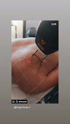 Photo n°18 de Dr Benoit Henault - Chirurgie esthétique Nîmes à Nîmes (Service de détatouage)