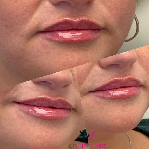 Lily Lips & Nose