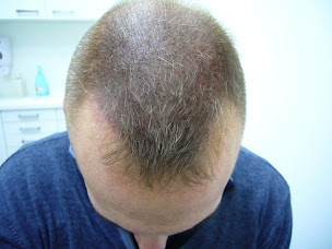 Photo n°9 de Clinique de la Dermographie Capillaire à Paris (Service de remplacement capillaire)