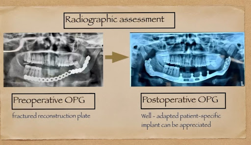 At LBS Dental & Maxillofacial Clinic, precision and planning make the difference. post image