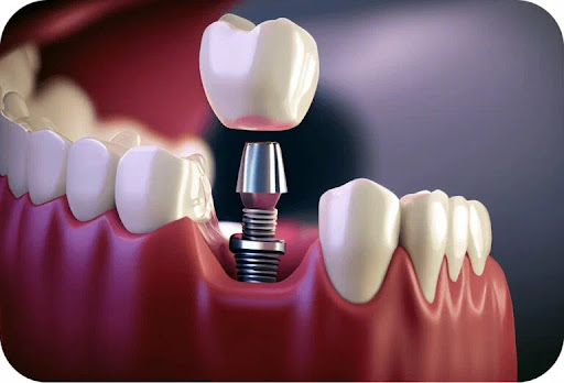 As a leading dental clinic in Yavatmal, we provide comprehensive services supported by advanced t… post image