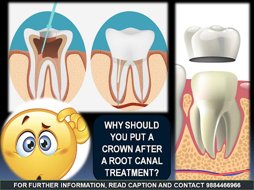 Root canal therapy is a dental procedure where the dentist gains access to the center of a tooth…