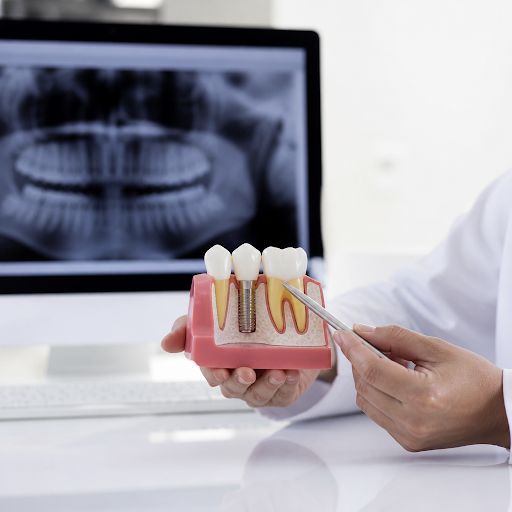 Dental implants are a long-term investment in your smile, confidence, and health. At Sree guru ko… post image