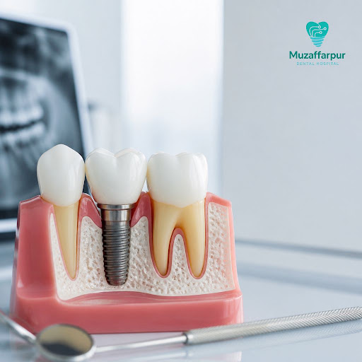 Modern dental implants no longer mean long, painful healing. At Muzaffarpur Dental Hospital, we u… post image