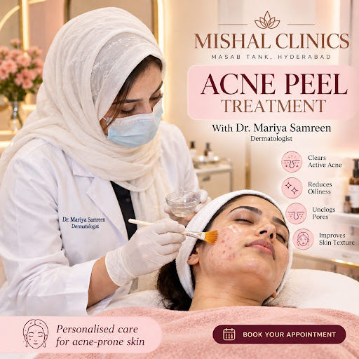 Acne Peel for Pimples & Acne post image