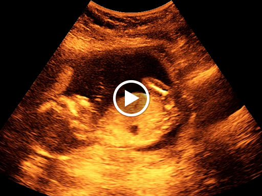 Mobile Diagnostic Ultrasound 2d 3d 4d In Office Or At Home Call Or Text 301 605 5572 Pregnancy Pelvic Abdominal Small Parts Vascular Embarazo Ultrasonido Hablamos Espanol Medical Diagnostic Imaging Center In Rockville