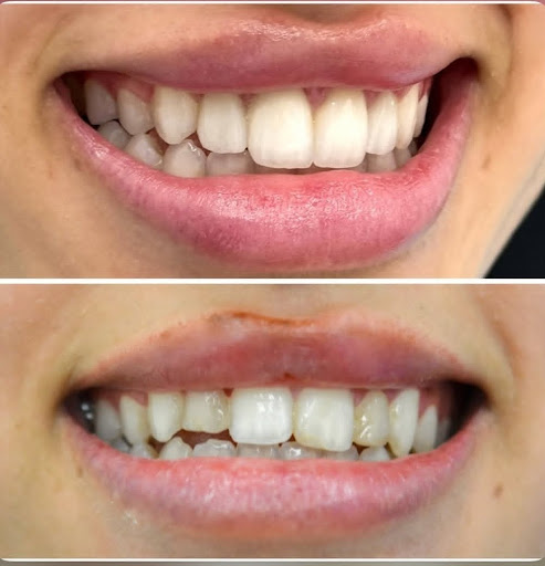 ✨ Bride-to-be Smile Transformation at Sunfill Dental Clinic, Wagholi ✨ post image