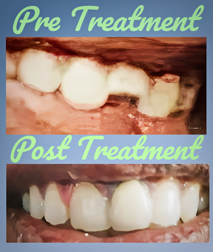 Patient reported with a fractured teeth with a cystic lesion. Treated and restored the teeth to f… post image