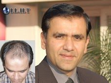 ILHT Hair Transplant Surgery Center Lahore