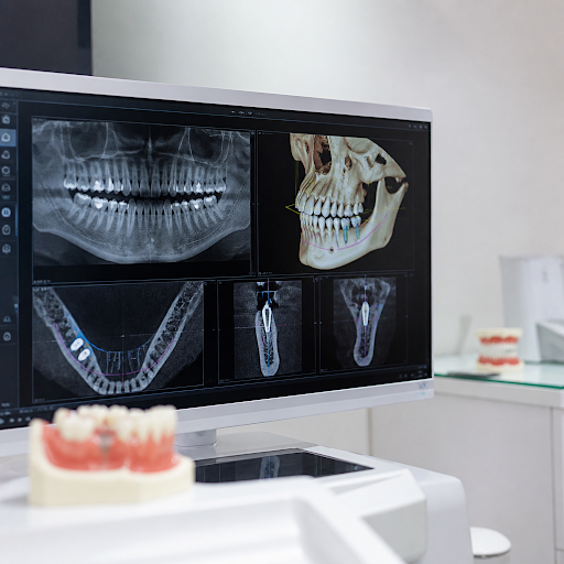At Mahamana Dental Clinic varanasi, we use advanced 3D imaging to plan safer, more accurate denta… post image